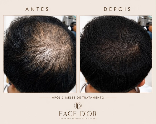 Antes e depois do tratamento capilar para fortalecimento dos fios em Morumbi