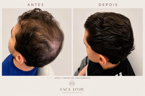 Antes e depois do tratamento para aumento da densidade capilar em Portal do Morumbi