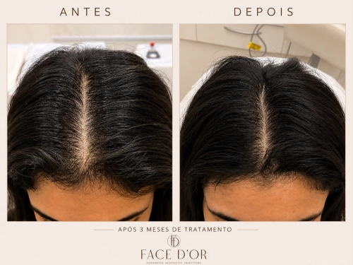 Antes e depois do tratamento para redução da queda de cabelo em Vila Andrade