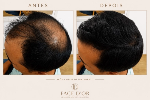 Antes e depois do tratamento estético capilar com resultados naturais em Portal do Morumbi
