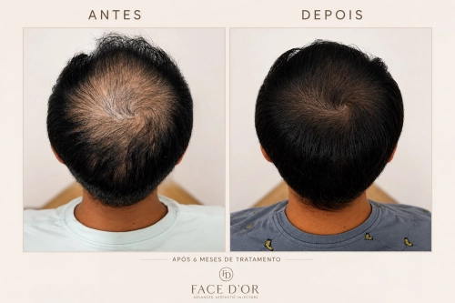 Evolução do tratamento capilar com antes e depois em Panamby
