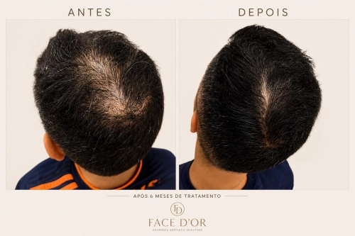 Resultados do tratamento capilar com antes e depois em Jardim Sul