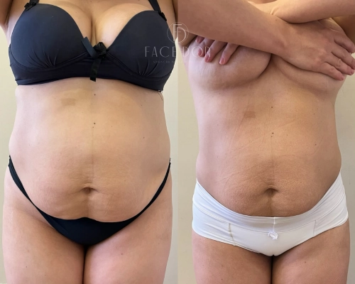 Transformação corporal antes e depois do tratamento estético em Morumbi