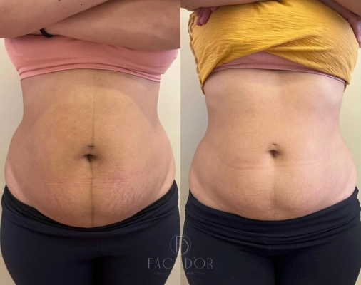 Antes e depois do tratamento para gordura localizada em Vila Andrade