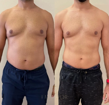 Tratamento corporal com redução de medidas e definição do corpo em Jardim Sul
