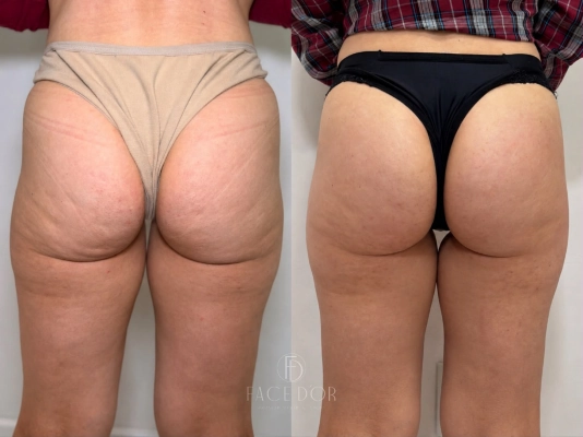 Antes e depois da evolução estética corporal em Jardim Sul