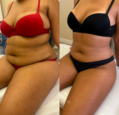 Antes e depois do tratamento corporal em Jardim Sul
