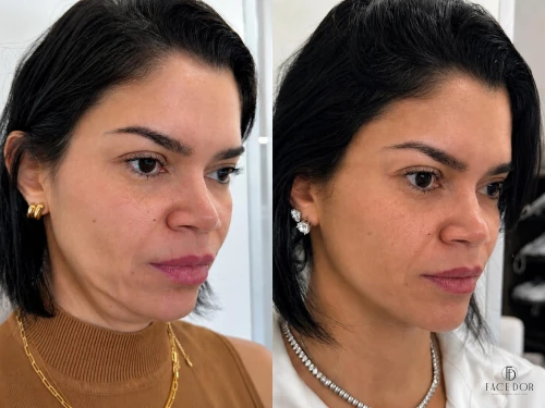 Antes e depois da harmonização facial em Morumbi