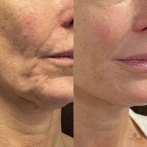 Resultado da harmonização facial em Vila Andrade