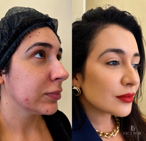 Antes e depois da harmonização facial em Jardim Sul