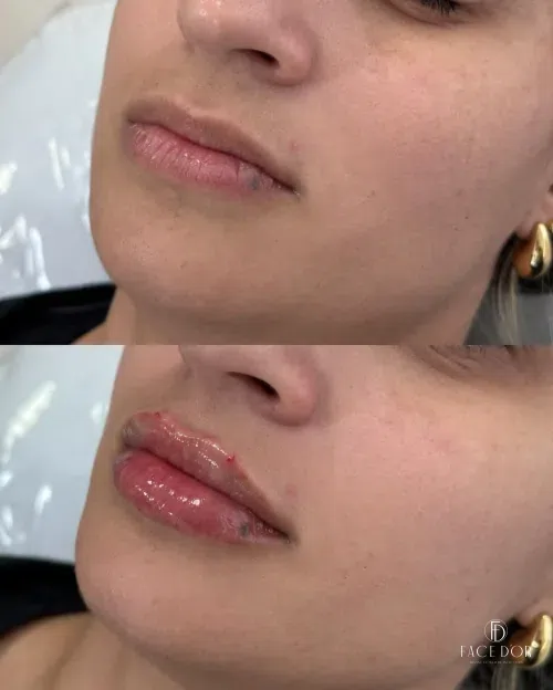Antes e depois do preenchimento labial em Morumbi