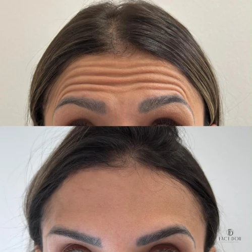 Resultado do Rejuvenescimento Facial em Portal do Morumbi