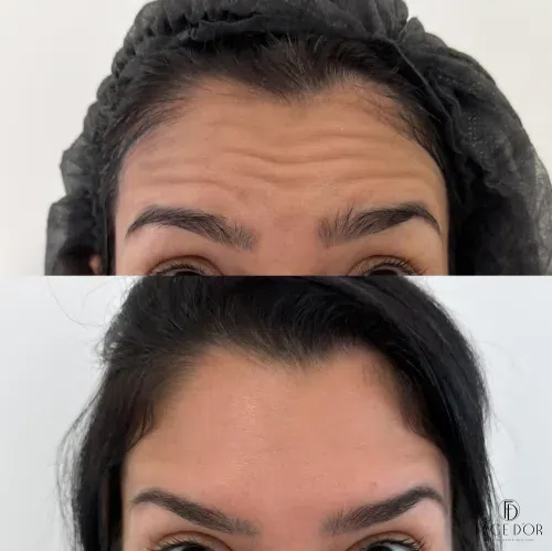Antes e depois do Rejuvenescimento Facial em Jardim Sul